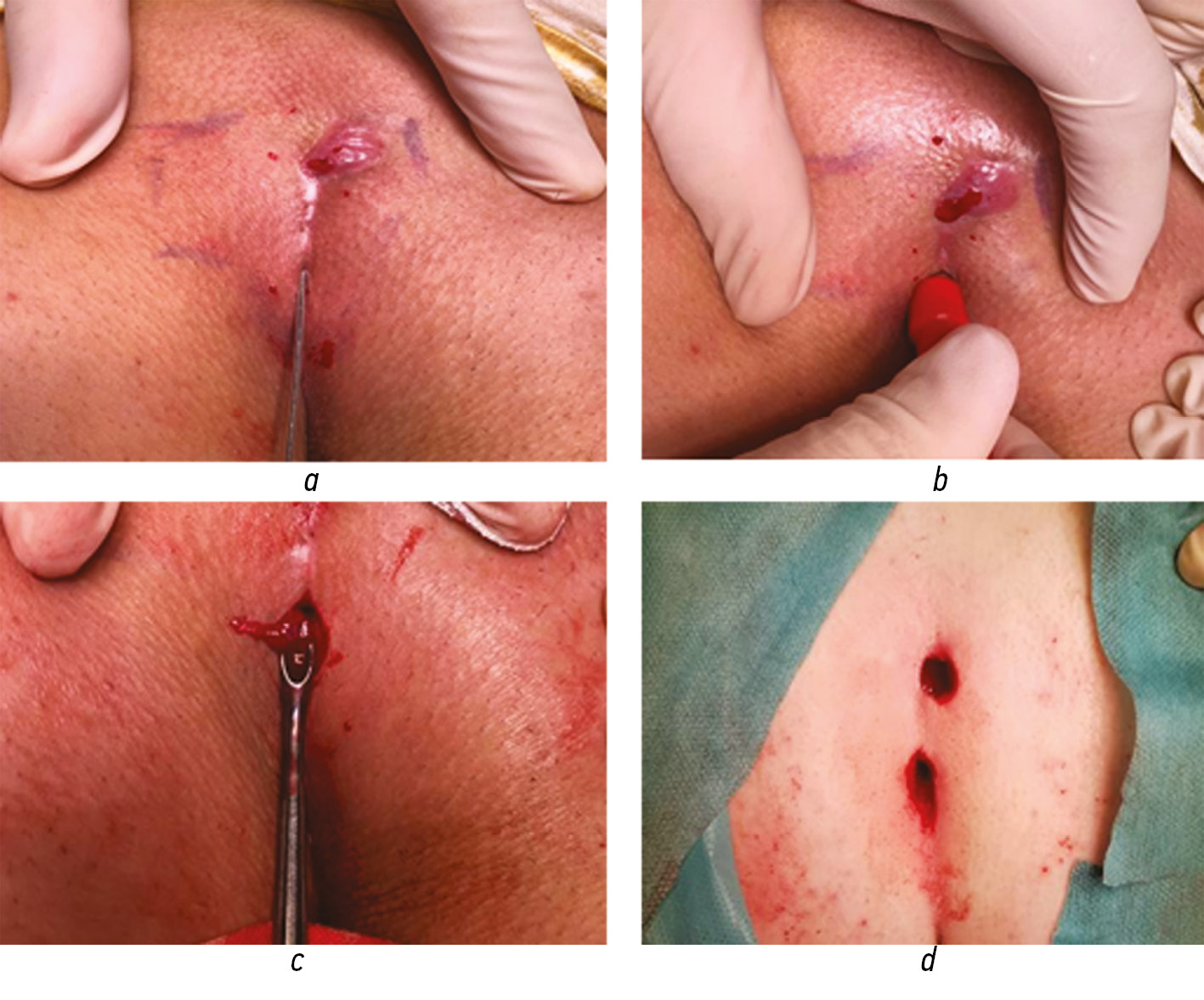 The Gips Procedure for Pilonidal Disease: A Retrospective Review of  Adolescent Patients