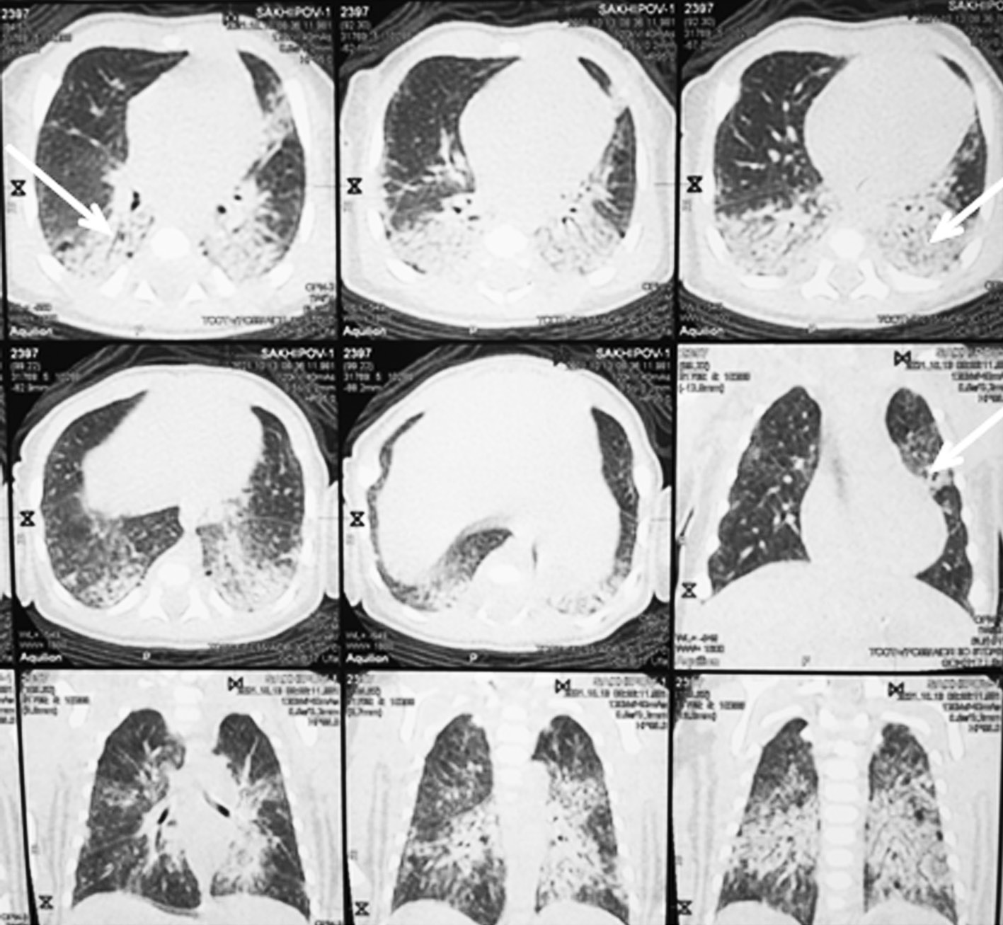 Pneumothorax in newborns with multisystem inflammatory syndrome associated  with COVID-19: a case reports - Shangareeva - Russian Journal of Pediatric  Surgery, Anesthesia and Intensive Care