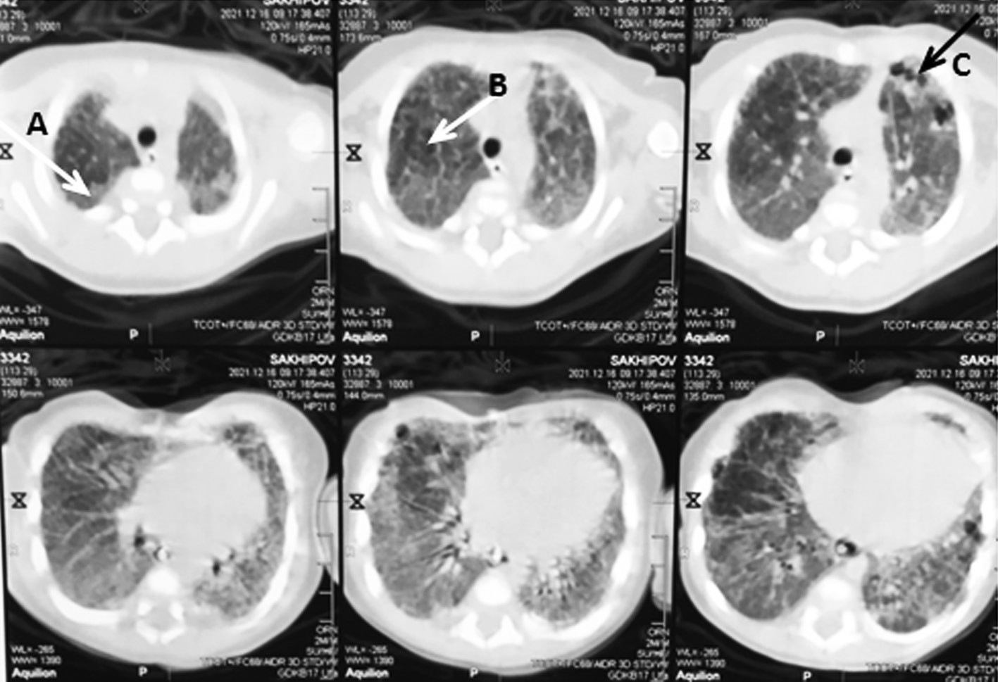 Pneumothorax in newborns with multisystem inflammatory syndrome associated  with COVID-19: a case reports - Shangareeva - Russian Journal of Pediatric  Surgery, Anesthesia and Intensive Care