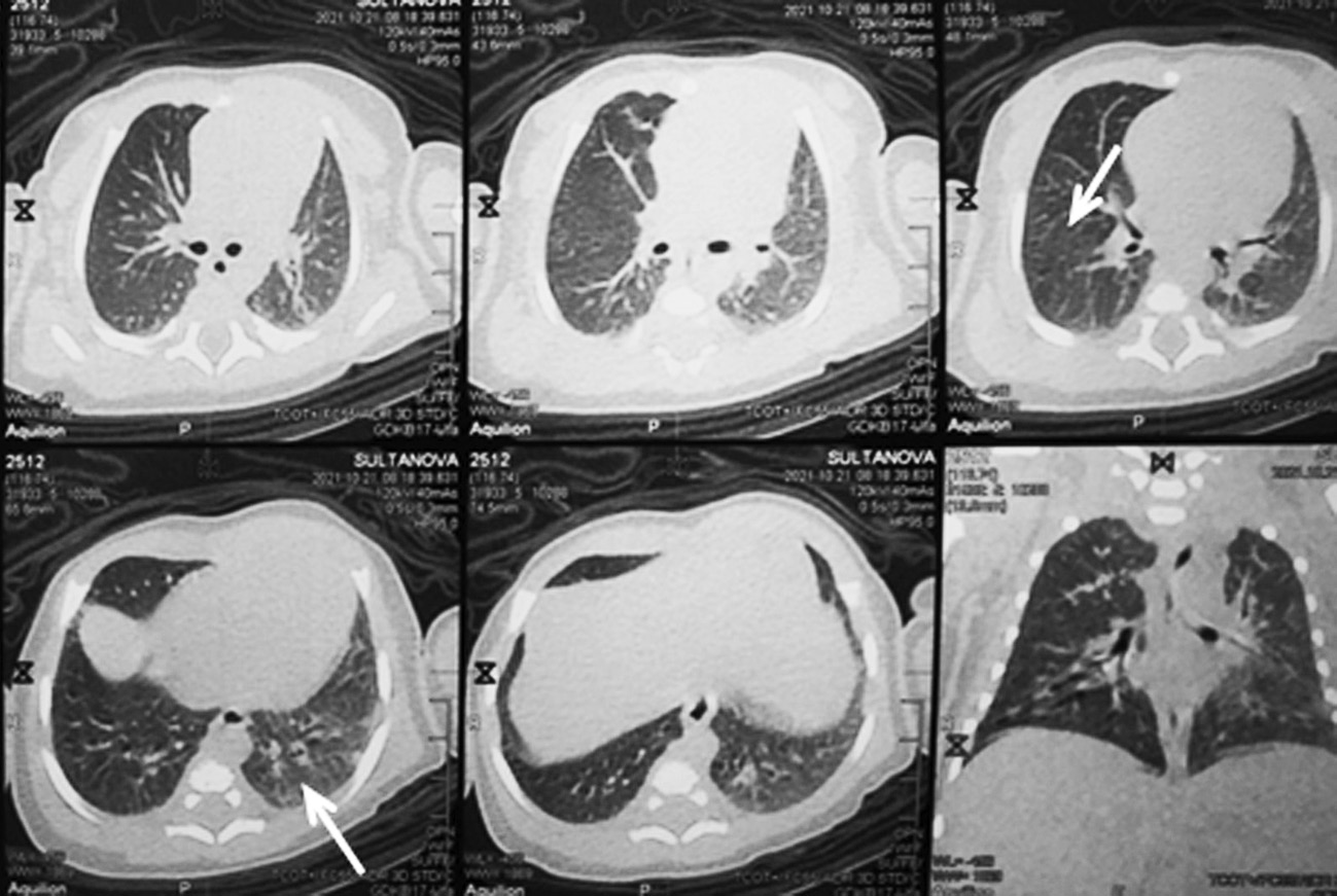 Pneumothorax in newborns with multisystem inflammatory syndrome associated  with COVID-19: a case reports - Shangareeva - Russian Journal of Pediatric  Surgery, Anesthesia and Intensive Care