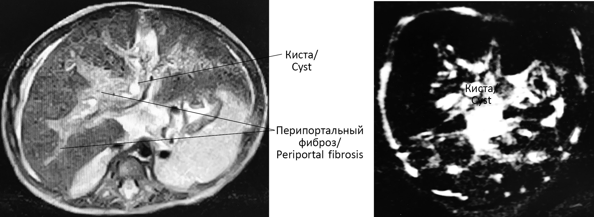 Ахоличный стул у детей