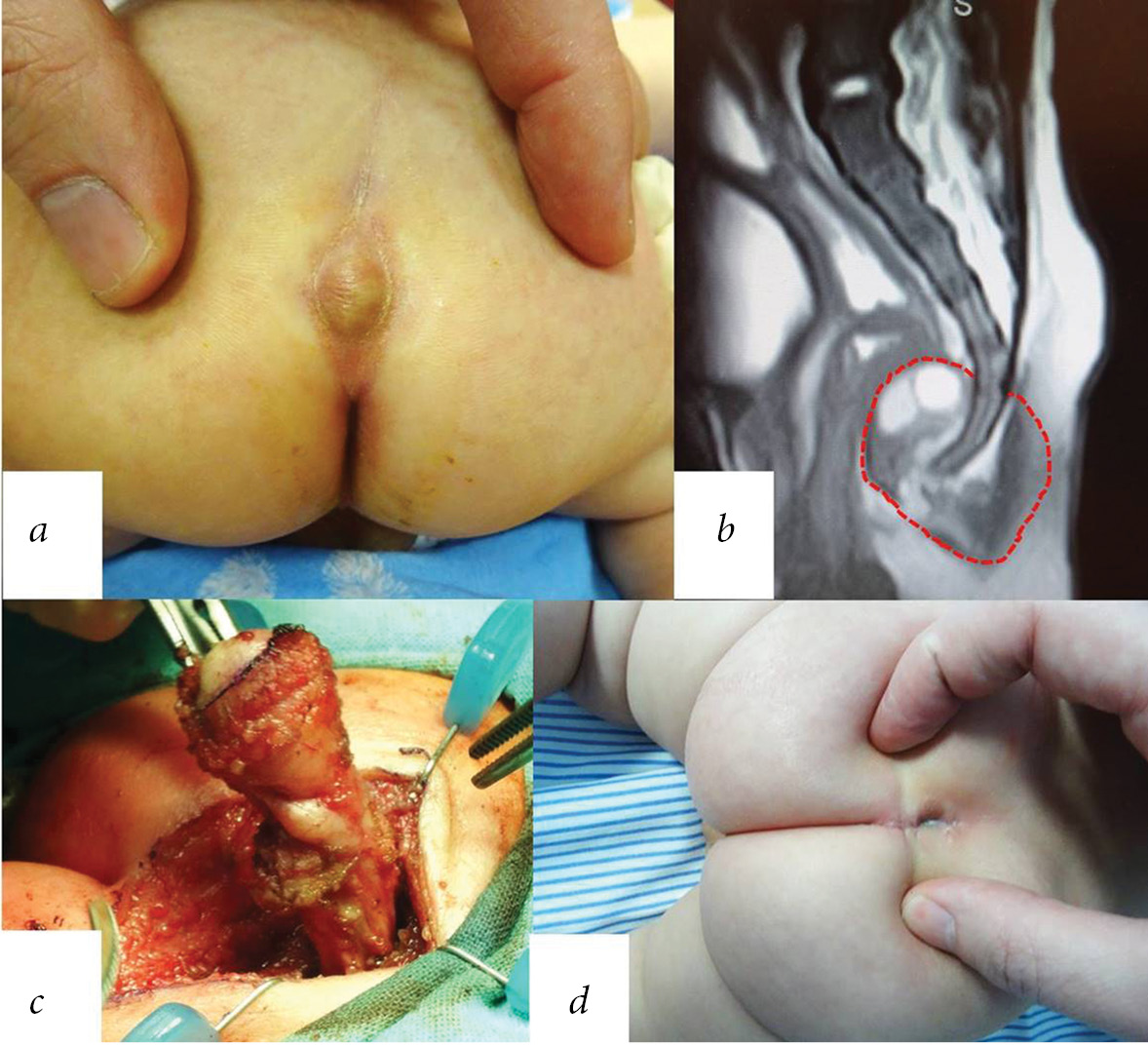 Sacrococcygeal teratomas in newborns: peculiarities in diagnostics and  treatment of small-sized tumors - Gopienko - Russian Journal of Pediatric  Surgery, Anesthesia and Intensive Care