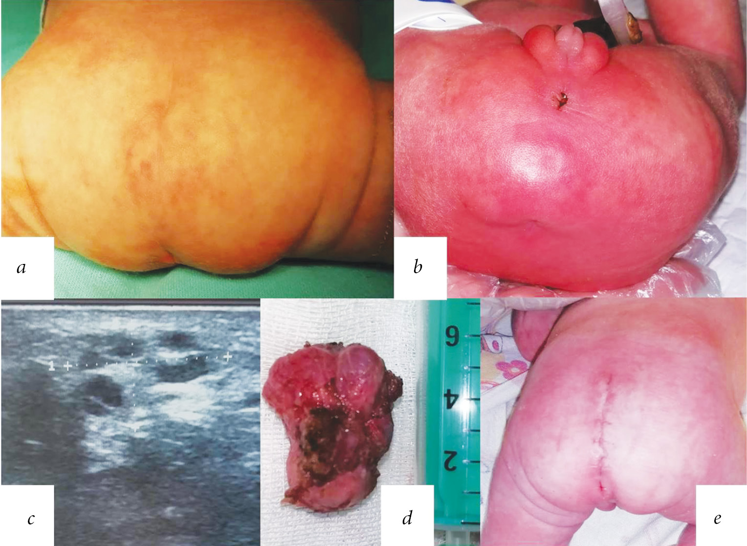 Sacrococcygeal teratomas in newborns: peculiarities in diagnostics and  treatment of small-sized tumors - Gopienko - Russian Journal of Pediatric  Surgery, Anesthesia and Intensive Care