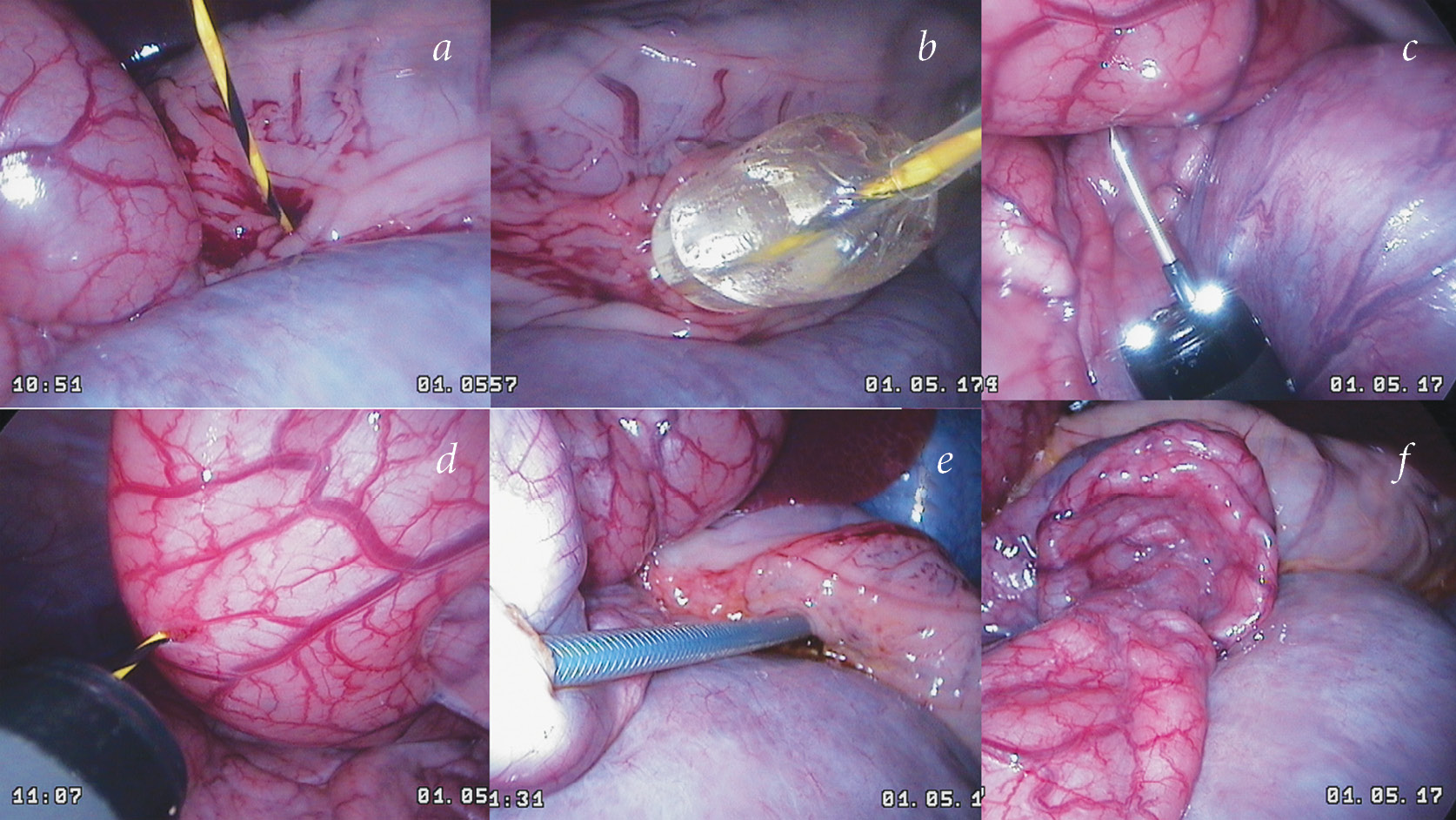 Gastroenteroanastomosis using NOTES-technologies — results of an  experimental study - Smirnov - Russian Journal of Pediatric Surgery,  Anesthesia and Intensive Care