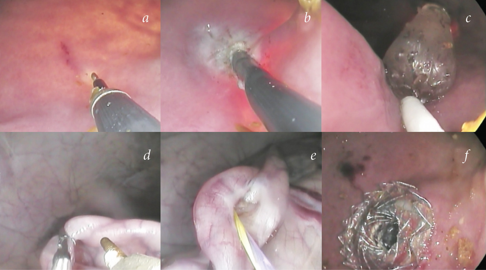 Gastroenteroanastomosis using NOTES-technologies — results of an  experimental study - Smirnov - Russian Journal of Pediatric Surgery,  Anesthesia and Intensive Care