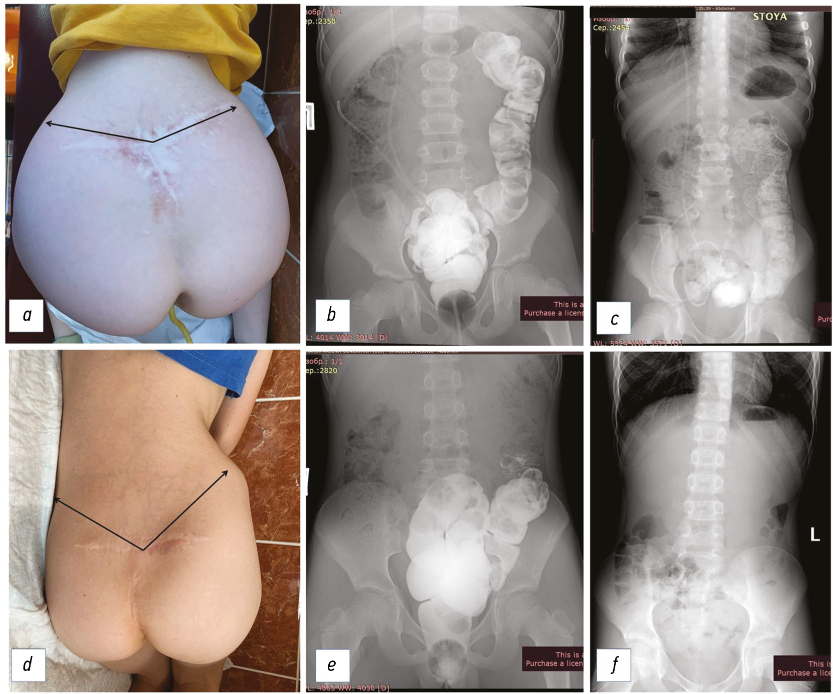 Bowel Management” program for children with congenital malformations and  neurogenic bowel after surgery - Pimenova - Russian Journal of Pediatric  Surgery, Anesthesia and Intensive Care